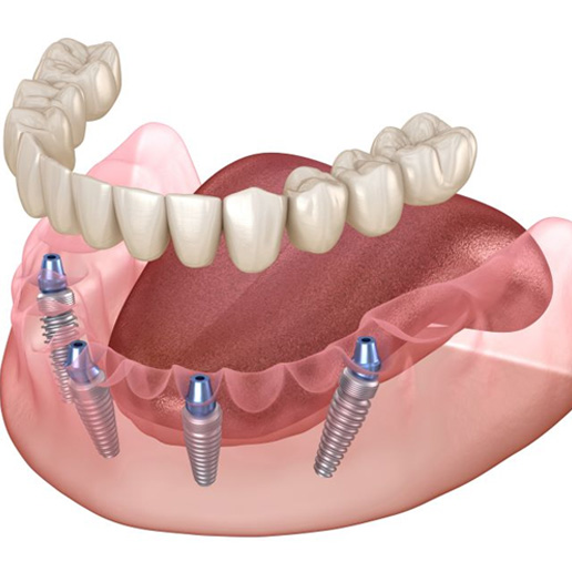 Illustration of All-on-4 dental implants for lower arch