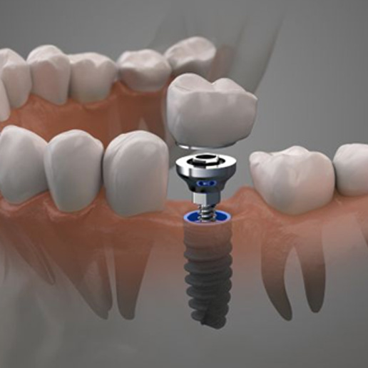 Traditional dental implant pictured between natural teeth