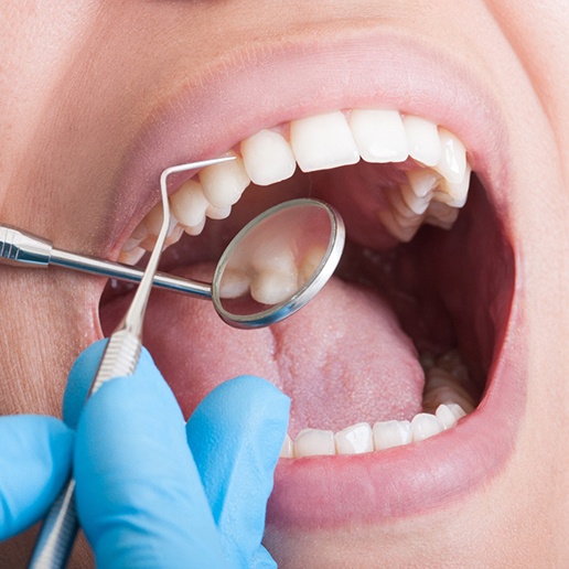 A hygienist performing a dental cleaning