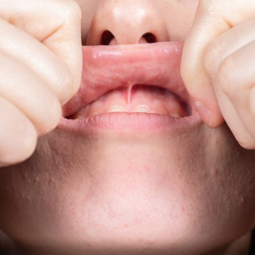 Close up of person lifting up and stretching their upper lip
