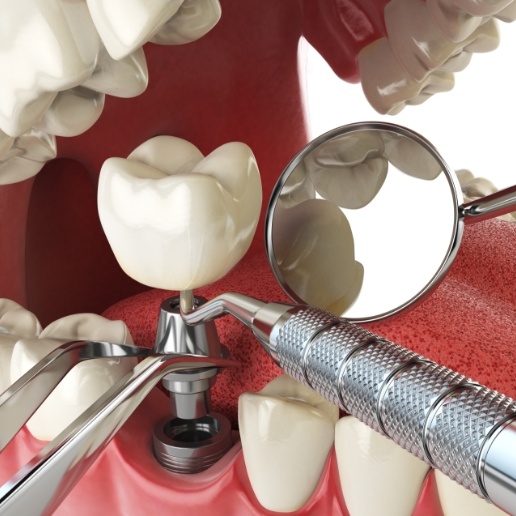 Animated parts of a dental implant