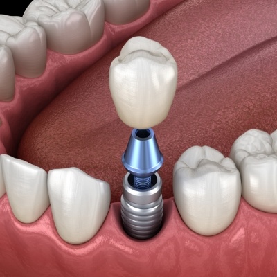 Animated dental implant with crown replacing one missing tooth