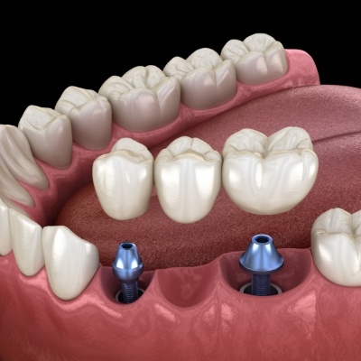 Two animated dental implants with dental bridge replacing three missing teeth