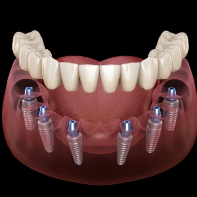 Six animated dental implants supporting a full denture