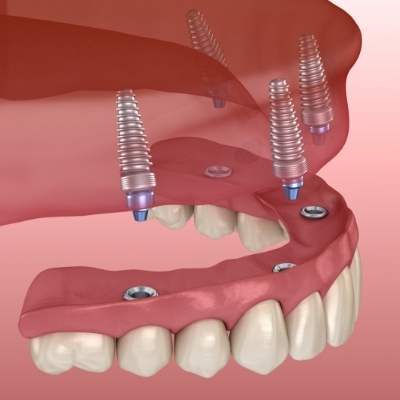 Animated All on 4 implant denture replacing the upper arch of teeth
