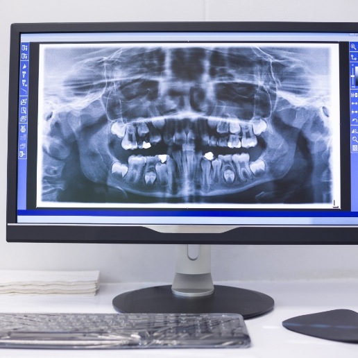 Computer screen showing digital dental x rays of a person's mouth