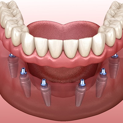 Example of full denture at United Dental Centers of Merrillville
