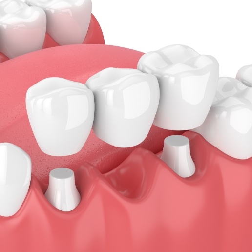 Animated dental bridge replacing missing teeth in Merrillville