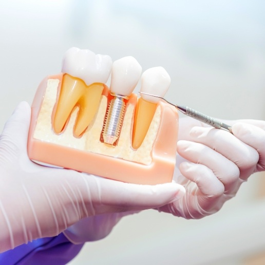 Dentist holding a model of a dental implant in the jaw