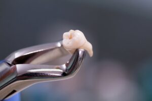 Forceps holding a tooth.